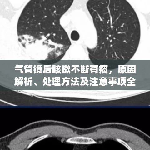 氣管鏡后咳嗽不斷有痰，原因解析、處理方法及注意事項(xiàng)全攻略
