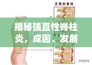 揭秘強(qiáng)直性脊柱炎，成因、發(fā)展與突發(fā)性的真相解析